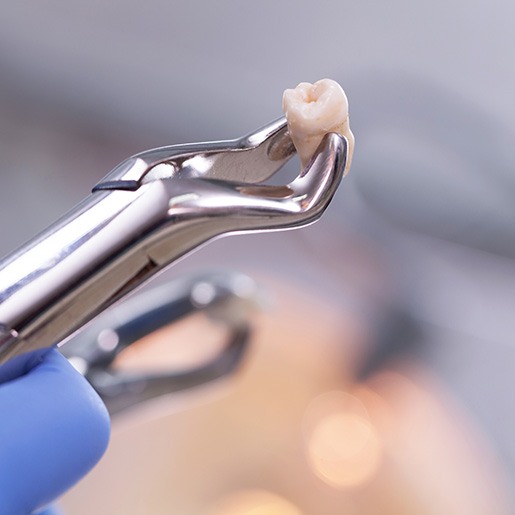 Closeup of forceps grasping an extracted tooth